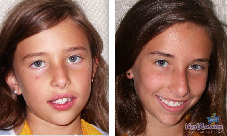 Ortodoncia en niños