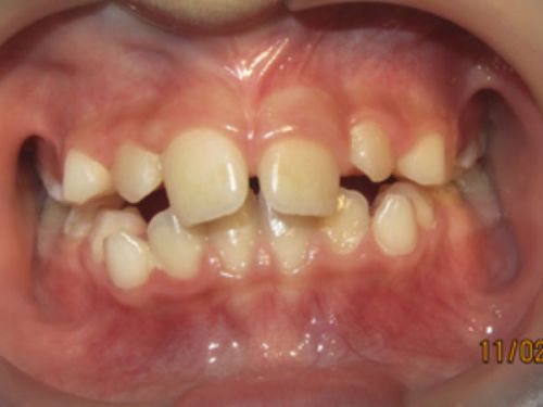 ortodoncia-temprana1