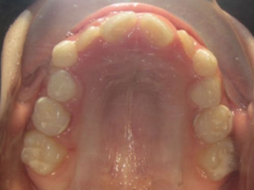 ortodoncia-temprana3
